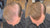 Hair Styles for Men with Balding Hair