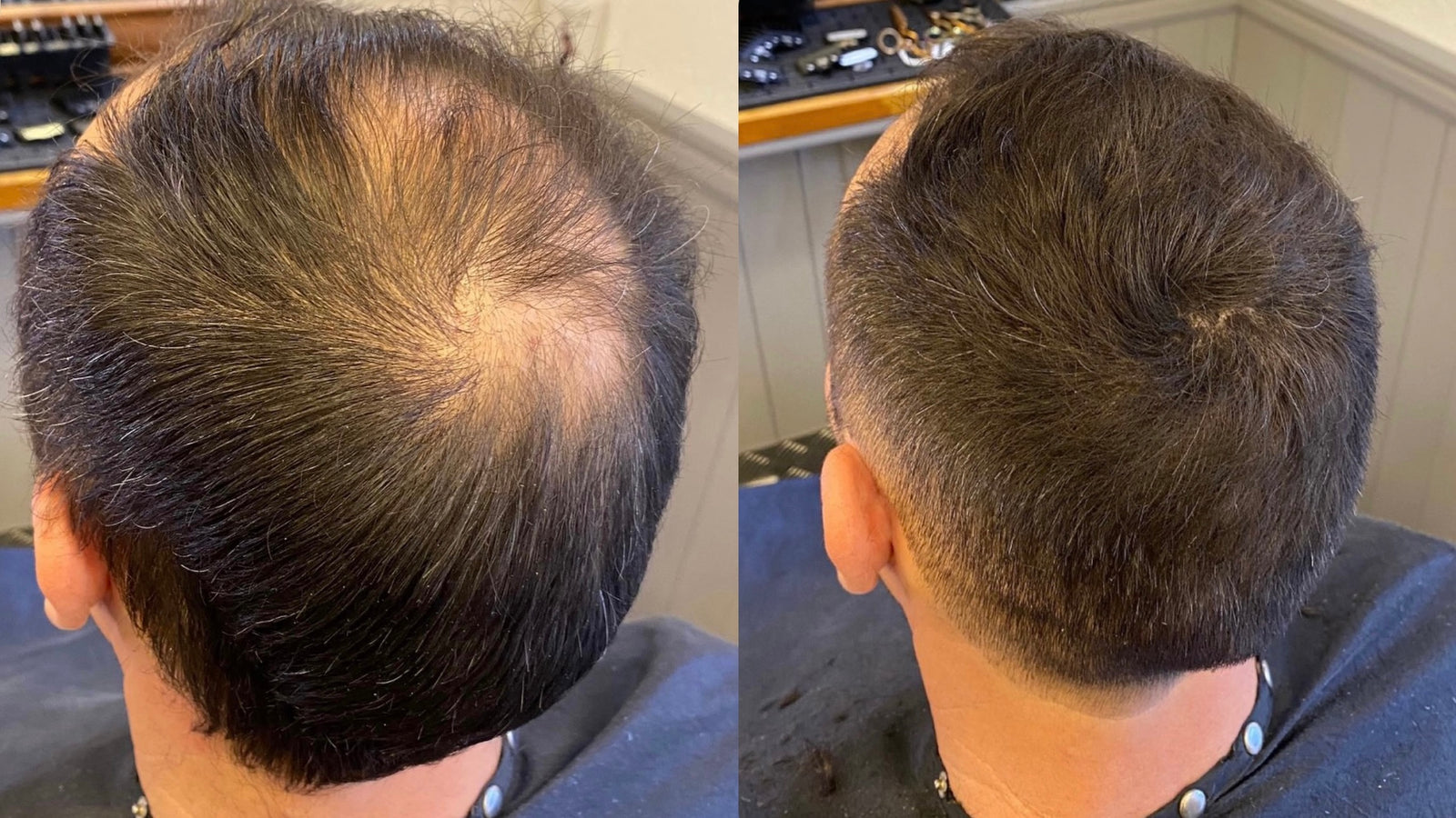 Celeb Innovative Solutions for Thinning Hair