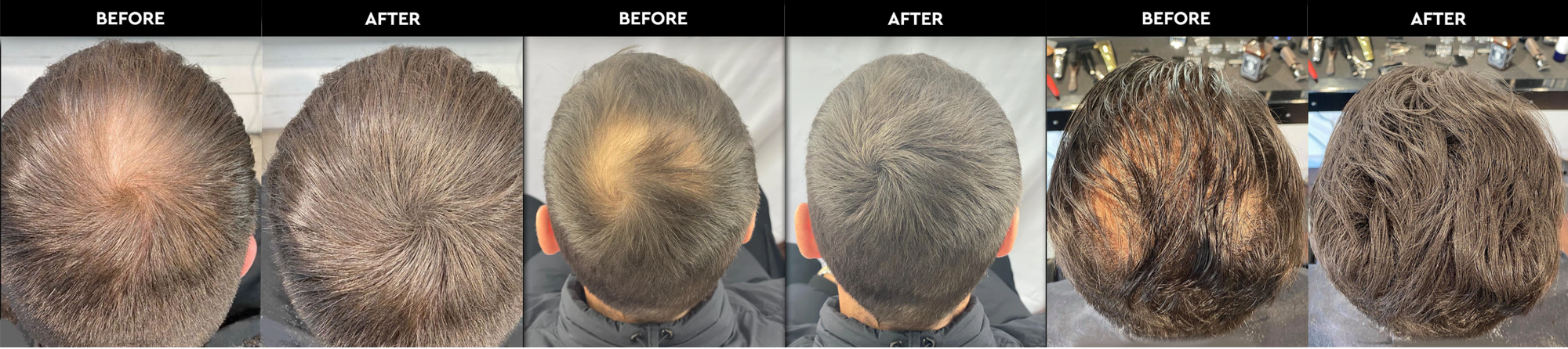 Mental Health and Hair Loss | Understanding the Link