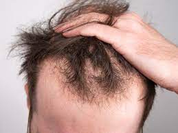 Hair Thickening Treatments for Men